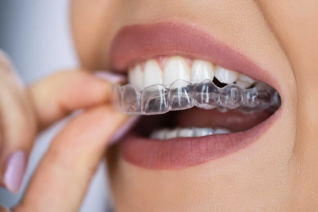 Does Insurance Cover Invisalign