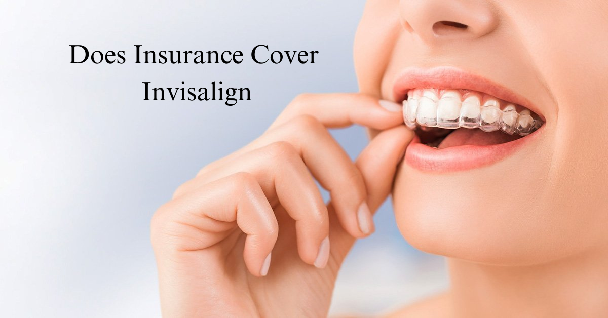 Does Insurance Cover Invisalign