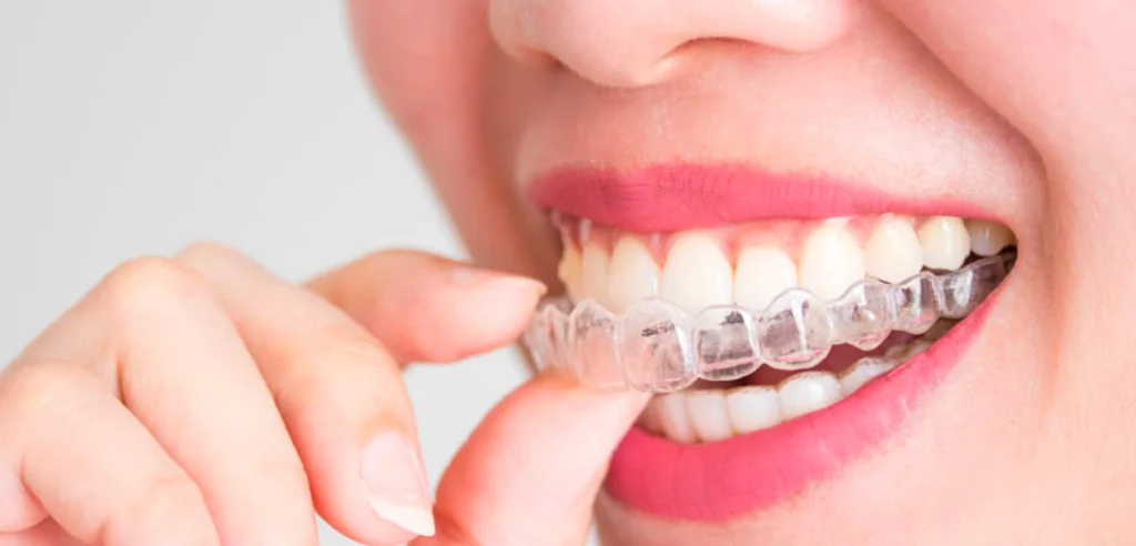 Does Insurance Cover Invisalign